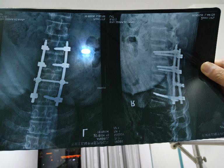 我在石家莊市江蘇省泰興市第一建筑安裝工程有限公司某工地因工受傷后的遭遇 第6張 我在石家莊市江蘇省泰興市第一建筑安裝工程有限公司某工地因工受傷后的遭遇 第6張